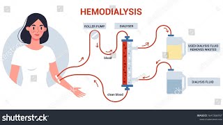 Que es la hemodiálisis Como se realiza Accesos vasculares y entre otras [upl. by Griffy383]