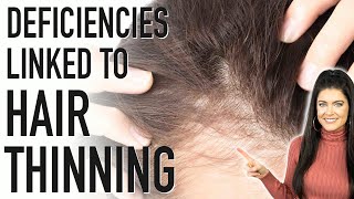 HAIR THINNING  5 Nutrient Deficiencies Linked to Hair Loss and how to fix it [upl. by Aiym995]