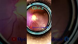 Glaucoma suspect  Smartphone Fundus Videography  Fundus Photography  Short Video 65 [upl. by Hterag]