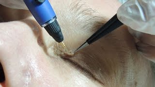 SKIN TAG REMOVAL [upl. by Kippar]