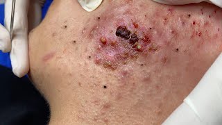 Big Cystic Acne Blackheads Extraction Blackheads amp Milia Whiteheads Removal Pimple Popping  65767 [upl. by Hach]