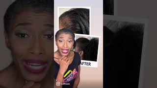 TRACTION ALOPECIA REVERSED [upl. by Sivrahc]