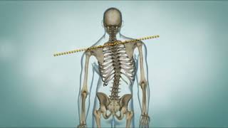 What is Scoliosis  signs and symptoms amp Treatment options [upl. by Laeno]