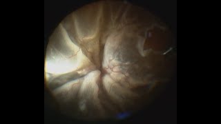 Funnel Retinal Detachment and Cataract with Posterior Synechiae [upl. by Fronia]