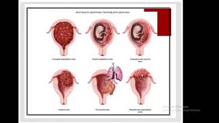 Gestational Trophoblastic Disease Vesicular Mole [upl. by Dadirac]