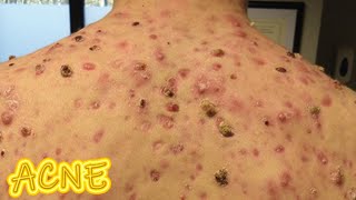 Acne Vulgaris Worlds Worst Acne Real and Fake [upl. by Enelrats]