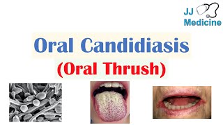 Oral Candidiasis Oral Thrush  Causes Pathophysiology Signs amp Symptoms Diagnosis Treatment [upl. by Dove]