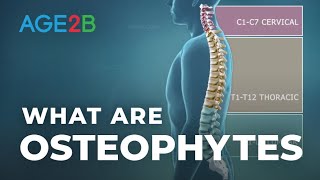 What Are Osteophytes  Spinal Bone Spurs  Anatomy  Degenerative Disc Disease [upl. by Levona]