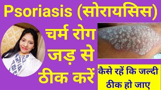 सोरायसिस का पूरा इलाज  Psoriasis Best homeopathic treatment in Hindi  Psoriasis skin disease [upl. by Wohlert]