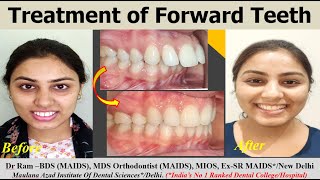 Satisfying Braces Treatment of Forward Teeth with Poor Smile PreMidPost Rx Braces Dr Ram Delhi [upl. by Lurlene]