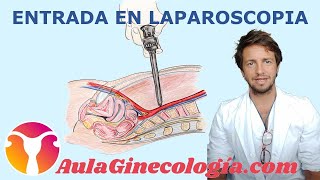 ENTRADA en LAPAROSCOPIA VERESS HASSON DIRECTA TRÓCARES SECUNDARIOS  Ginecología y Obstetricia [upl. by Becht180]