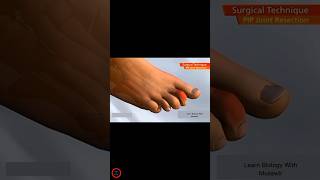 Hammertoe procedure animation  shorts [upl. by Leahcimnhoj]