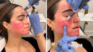 Getting the Vampire Facial 💉 You gotta see these results [upl. by Sivolc]