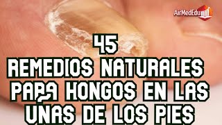 45 remedios naturales para los hongos en las uñas de los pies [upl. by Aleras]