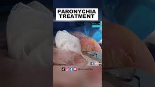 How to Treat Paronychia by Miss Foot Fixer Marion Yau [upl. by Aleedis]