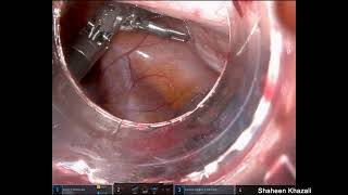 Robotic Assisted Excision of Accessory Cavitated Uterine Malformation [upl. by Luapnhoj766]