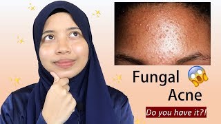 Everything You Need To Know About Fungal Acne [upl. by Enomal859]