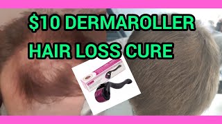 How I Use My Dermaroller for Hair Loss [upl. by Sokin]