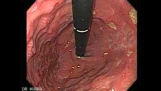 Endoscopy of Multiple Ulcers of the Stomach [upl. by Fitalludba776]