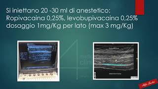 ADDOMINOPLASTICA IN ANESTESIA LOCALE CON TAP BLOCK [upl. by Ecinreb]