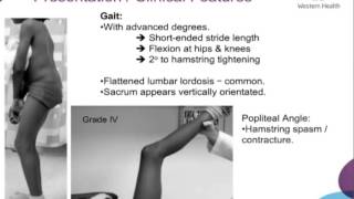 Spondylolisthesis by Dr Pandelis Dimitriou [upl. by Cord285]