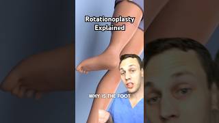 Why is the foot on backwards This is called a rotationplasty [upl. by Nod797]