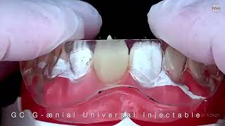 Injection Moulding Technique with Gænial Universal Injectable and GC Exaclear by Serhat Köken [upl. by Nalad]