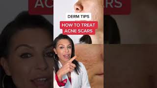 How to Treat Acne Scars According to a Dermatologist shorts [upl. by Quintessa]