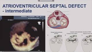 Pediatric Cardiac Anaesthesia Lecture 3 [upl. by Nodarse]