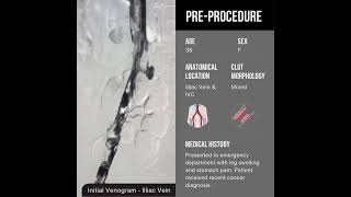 Thrombus in the Iliac Vein and IVC  Symphony™ Thrombectomy System [upl. by Aicil]