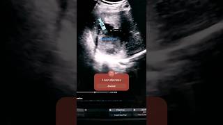 Liver abscessHepatic abscess ultrasound usg liverabscess trending subscribe ultrasoundtherapy [upl. by Coney]