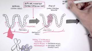 Colon Cancer Carcinogenesis [upl. by Nissa615]