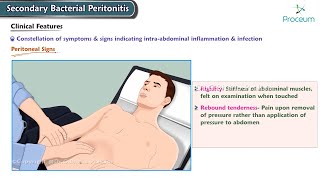 Secondary Bacterial Peritonitis Etiology Clinical features Diagnosis Management Surgery [upl. by Iona910]