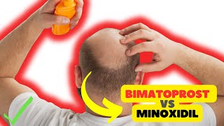 Bimatoprost vs Minoxidil Exploring Solutions for Hair Growth [upl. by Liberati]