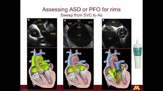 Diagnosis of SVT in the EP lab [upl. by Claudy]