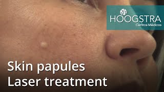 Skin papules  Laser treatment 21023 [upl. by Lattie]