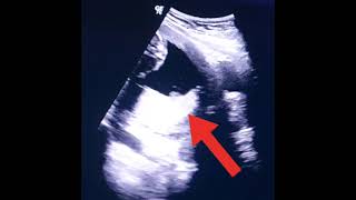 Low placenta in pregnancy  placenta previa  Anterior posterior placenta  Low lying placenta usg [upl. by Haymo]