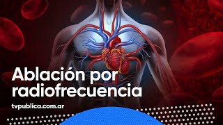 ¿Qué es la ablación por radiofrecuencia  En Casa Salud [upl. by Remmus266]