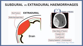 Subdural vs Extradural Haemorrhages Explained [upl. by Helfant]