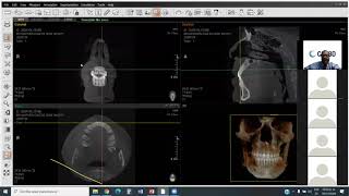 EZ3D Plus Manejo de software de Tomografía Cone Beam Dr Enrique Sierra Rosales [upl. by Rahas]