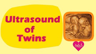 Sonography of Twins [upl. by Llenrub233]