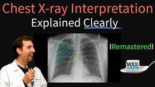 Chest X Ray Interpretation Explained Clearly  How to read a chest Xray [upl. by Sinnard495]