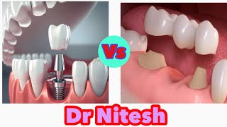 Dental Implant vs Bridge which one is better [upl. by Ahsienel]