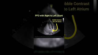 PFO with Right to Left Shunt Echocardiography [upl. by Lowe]