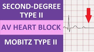 SecondDegree Type 2 Heart Block ECG Rhythm Nursing NCLEX  Mobitz Type II [upl. by Schatz]