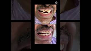 Best dental treatment in hyderabad Composite filling Dr Aravind’s [upl. by Enitnemelc]