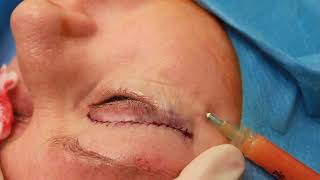 Superficial Enhanced Fluid Fat Injection For Facial Rejuvenation [upl. by Trotta]