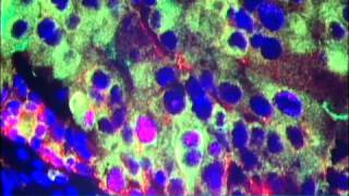 Nanoparticles for Cancer Treatment Video  Brigham and Womens Hospital [upl. by Tarton]