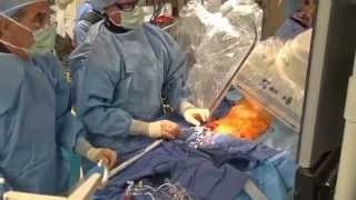 CoreValve Procedure I El Camino Hospital [upl. by Alek283]