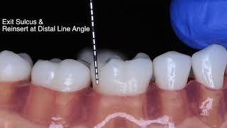 Periodontal Probe Basic Technique [upl. by Redmer]